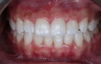 After image