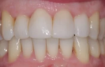 After image